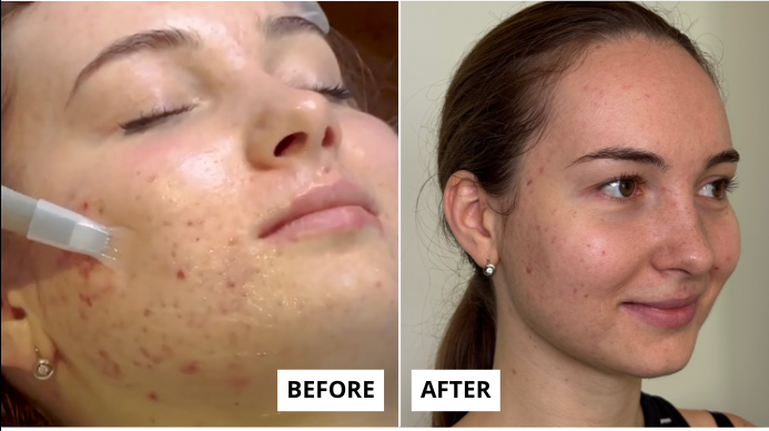 Skin Rejuvenation