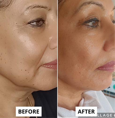 Skin Rejuvenation